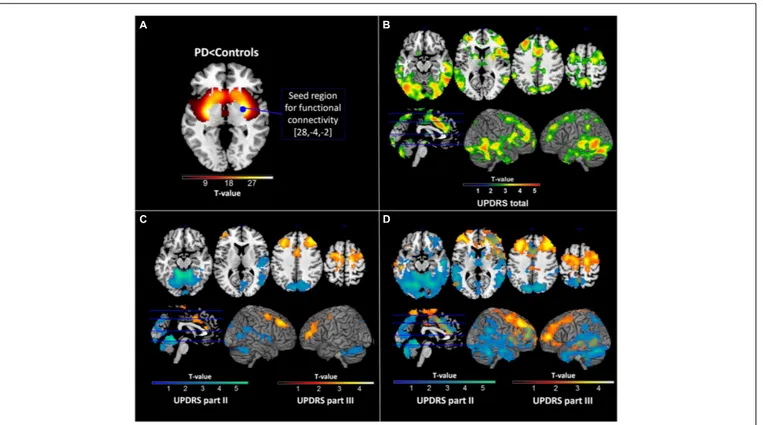 FIGURE 1 | Results of dopamine transporter single photon emission tomography (DAT-SPECT) and functional connectivity analyses