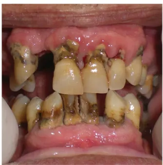 Figure 6. Erosions and sores on the lingual surfaces of the teeth.