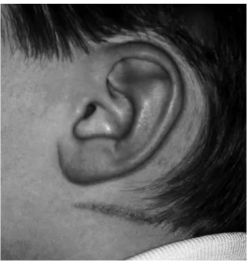 Fig. 1. Burn on the side of the neck of boy in an unusual site for an accidental injury (modified from child protection and the dental team, COPDEND 2006, Harris J, Sidebotham P, Welbury R et al., pp