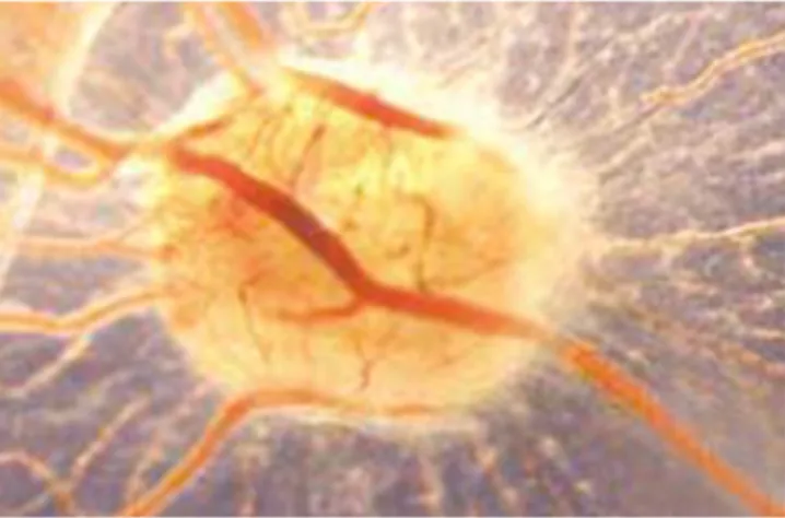 Fig. 6. A 12-day-old CAM incubated on day 8 for 4 days with bioptic specimen of a tumor xenograft, showing numerous host vessels around and inside the graft.