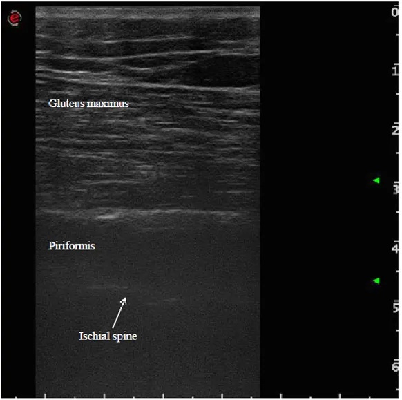 Figure 2. Ultrasound identification of the piriformis muscle between gluteus maximus 