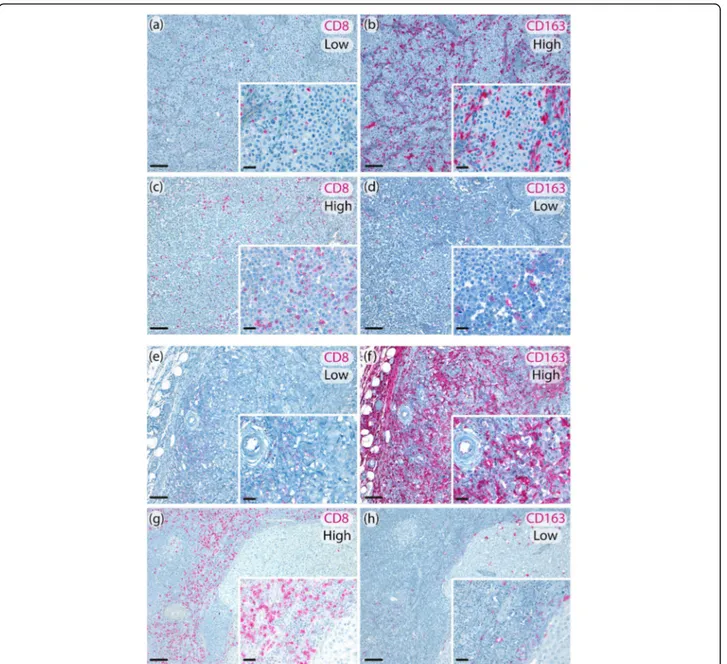 Fig. 2 Representative metastatic melanoma tissues showing intratumoral low CD8 + / high CD163 + expression (a, b); intratumoral high CD8 + /low