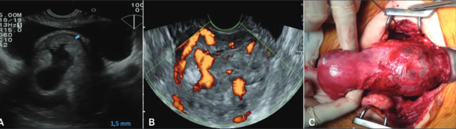 Figure 1. A, Transvaginal sonogram showing a retroverted uterus with a cesarean scar pregnancy surrounded by thin myometrium of 1.5 mm (blue