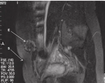 Figure 4.  Use of prolene mesh for the abdominal wall defect. 