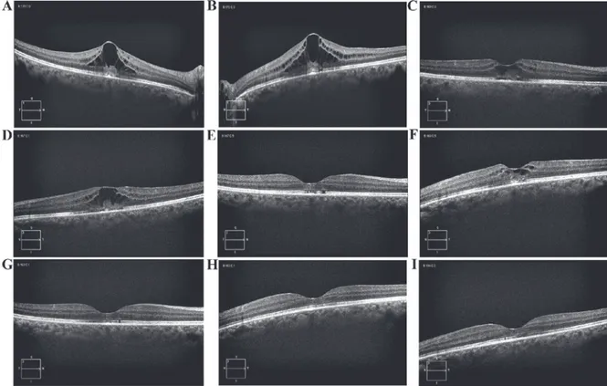 Figure 1. Spectral domain optical coherence tomography images derived from the present case study