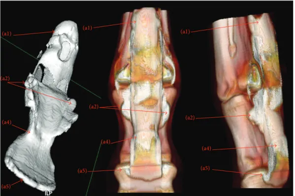 Figure 4: 3D reconstruction. (1) Surface rendering; (2) volume rendering. (a1) Dorsal proximal recess, (a2) palmar proximal recess, (a3) collateral recess, (a4) palmar distal recess, and (a5) dorsal distal recess.