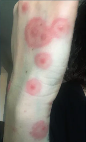 Figure 4.  Erythema multiforme mayor associated to viral in- in-fections.