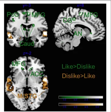 FIGURE 7 | Main effect of Liking for musicians only. ACC, anterior cingulate cortex; Caud, caudate; CG, cingulate gyrus; STG, superior temporal gyrus; MTG, middle temporal gyrus; AN, anterior nucleus of the thalamus; PcG, precentral gyrus; and MFG, middle 
