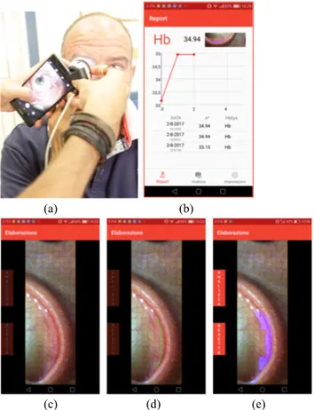 FIGURE 3. The modified macro-lens and the eyelid image captured.