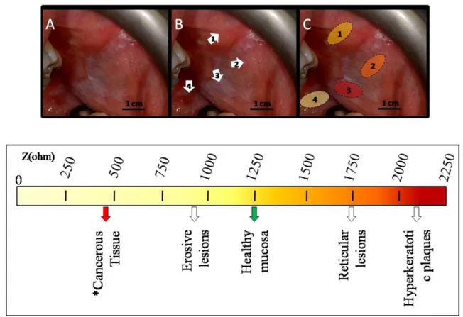 Figure 3. BIOIMPEDANCE LIMIT VALUES FOR OLP LESIONS NEOPLASTIC POTENTIAL. A: patient affected by OLP on the intraoral 