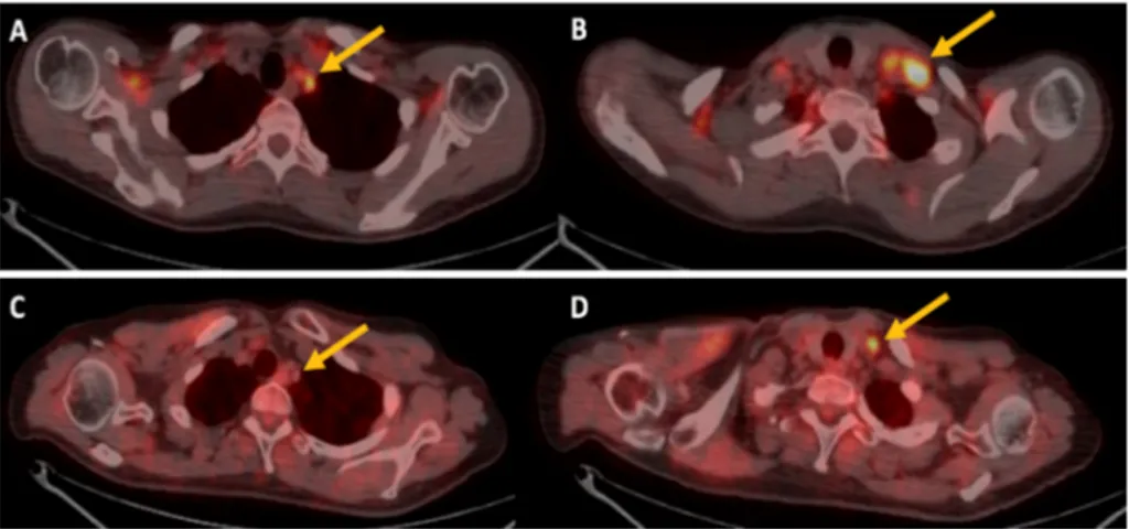 Figure 1.  18 F-FDG PET/CT imaging of a patient treated with bevacizuamb. (A,B) are transaxial PET/CT 