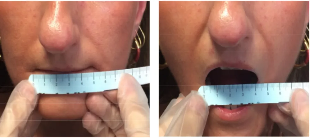 Figure 2. SSc patient. Microstomia has been measured as the distance between the lip commissures