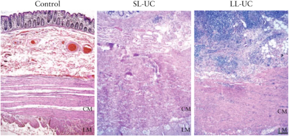 Figure 1.  Increased thickness of the inflamed colonic wall in short-lasting [SL] and long-lasting [LL] ulcerative colitis [UC], as compared with control colon