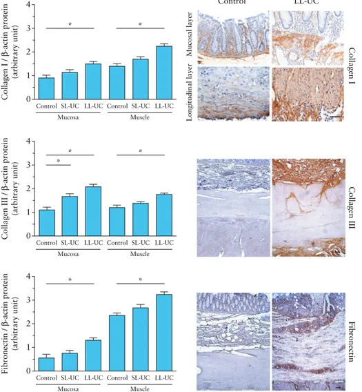 Figure  5.  Increase in collagen types I  and III and fibronectin in inflamed long-lasting [LL] ulcerative colitis [UC]