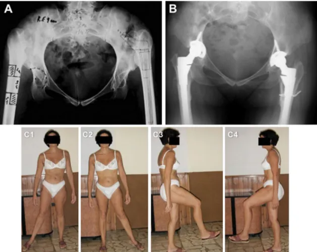 Fig. 1 44-year-old female patient with bilateral DDH. a Pre-opera- Pre-opera-tive planning with the Z-shaped osteotomy