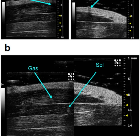 Figure 1.  Acoustic window used to visualize whole soleus (Sol) muscle. (a) Sample images acquired from 