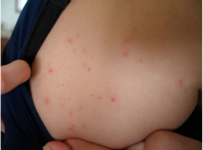 Figure 2. Dermanyssus gallinae-dermatitis caused by mites migrating from a sparrows ’ nest (original, M.A