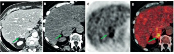 Figure 1.  A 74 years old man aﬀected by right adrenocortical carcinoma. Computed tomography transaxial image A) showed a 4.5cm solid adrenal mass characterized by an inhomogeneous enhancement after contrast enhancer injection (green arrow)