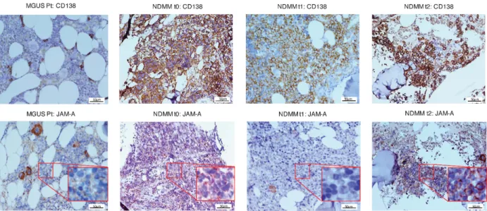Figure 2. JAM-A is overexpressed in bone marrow biopsies of MM patients. JAM-A immunohistochemical staining of BM trephines from a single representative MM patient (at t0, t1 and t2) compared with MGUS control