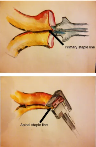 Figure 1 Configuration of side-to-side ileocolic anastomosis in right-sided colorectal resection (with thanks to Professor David Gourevitch for the illustrations).