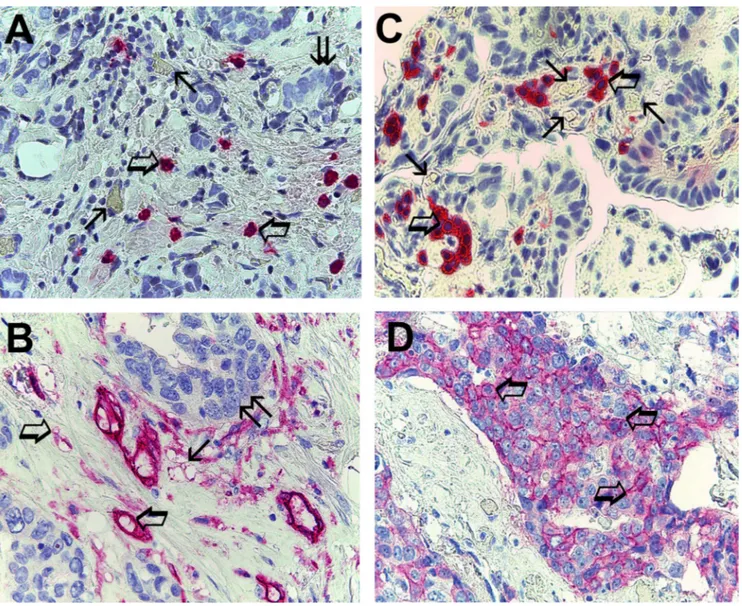 Figure 1:  (A) Breast cancer tissue sections evaluated by immunohistochemistry with the primary anti-tryptase antibody