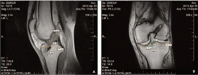 Figure 4. A, B, Sagittal and coronal T2 MRI exemplifying the trans AM graft obliquity measurements related to the tibial plateau.