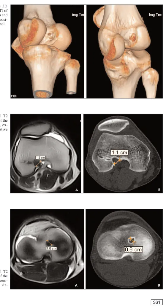 Figure 6. A, B, Axial T2 MRI and CT at the level of the femoral tunnel aperture,  ex-emplifying the comparative sizing.