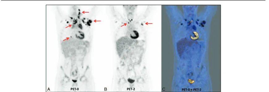 Figure 1. 18 F-FDG PET/CT performed in a 16-year-old female affected by Nodular Sclerosis Hodgkin lymphoma at stage IIIA