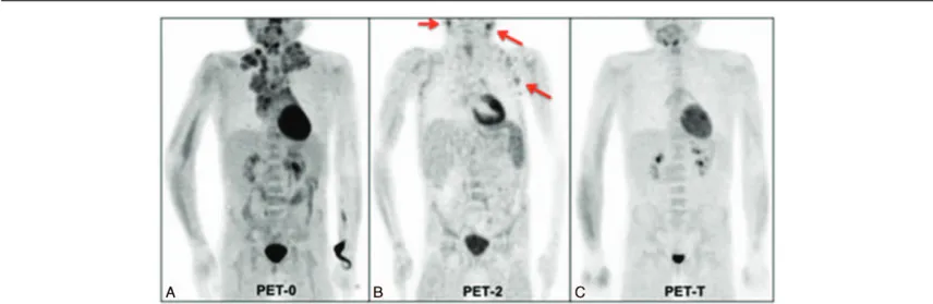 Figure 5. (A–C) 18 F-FDG PET/CT performed in a 9-year-old male affected by nodular sclerosis Hodgkin lymphoma at stage IIIB