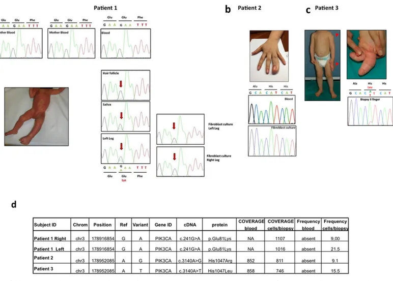 Fig 1. Clinical and mutational spectrum of the three index cases. a Patient 1, clinically diagnosed with MCAP, showing diffuse capillary malformation at the age of 2 months and cutaneous syndactyly between the 2 nd and 3 rd toes