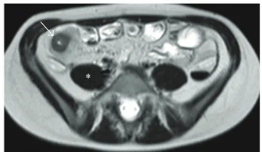 Figure 2: MRE, T2W axial image. Edema was diagnosed when the involved loops (arrow) showed higher signal intensity compared with psoas muscle (∗) in T2W images.