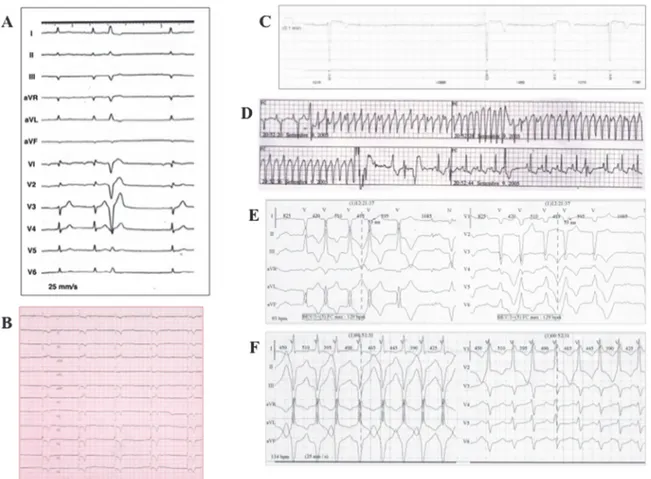 Fig 2. Clinical characteristics of index patient and LMNA mutation-positive family members