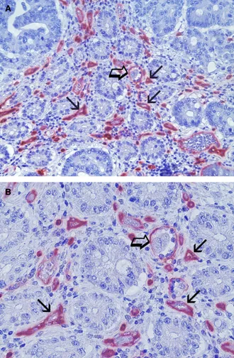 Fig. 1 Colon cancer sections red immunostained with the primary anti- anti-CD68 antibody specific for the macrophages identification