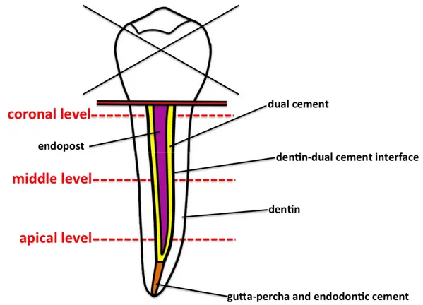 Figure 1. Schematic drawing of the endodontically treated root showing the three levels analyzed