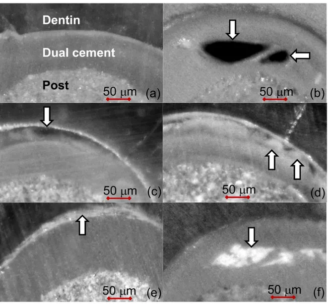 Figure 2. Seventy-micrometer thick unstained sections (enlargement of 40×): White arrows  indicate the five defects detected: (a) defectless slice; (b) bubbles within the dual cement layer;  (c) detachments at the dual cement-dentin interface; (d) polymeri