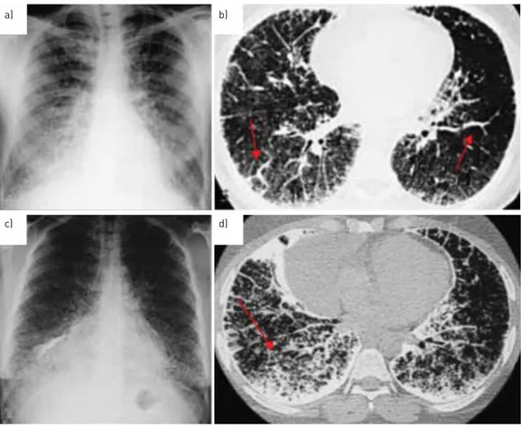 FIGURE 3 Evolutionary radiological phases of pulmonary alveolar microlithiasis. a) Chest radiograph of the third phase: extremely dense, uniform distribution of radio-opaque bright punctiform elements, with sandstorm appearance
