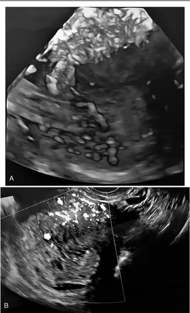 Figure 1. Transvaginal ultrasound examination of the Case 1, before D&amp;C (Dilatation and Curettage)