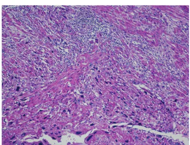 Figure 6. Immunohistochemistry for beta-HCG of the Case 1. These neoplastic intermediate trophoblastic cells were strongly positive for  beta-HCG