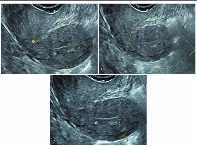 Figure 7. Pre-operative trans-vaginal ultrasound of the Case 2. A trans-vaginal ultrasound revealed a suspicious endometrial thickness, in the medium third of the uterine cavity, measuring 4.5 mm (A), negative at the Color-Doppler evaluation (B), without m