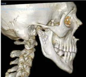 Fig. 5 Subcondylar fracture with displacement: loss of vertical dimension and open bite.