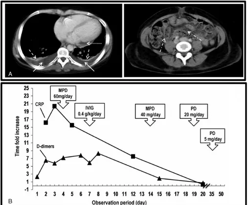 FIGURE 1. (A) Computerized axial tomography of chest (left panel) and abdomen-pelvis (right panel) during the acute event and (B) C-reactive protein and D-dimers changes during the acute event and in the days after therapy was started