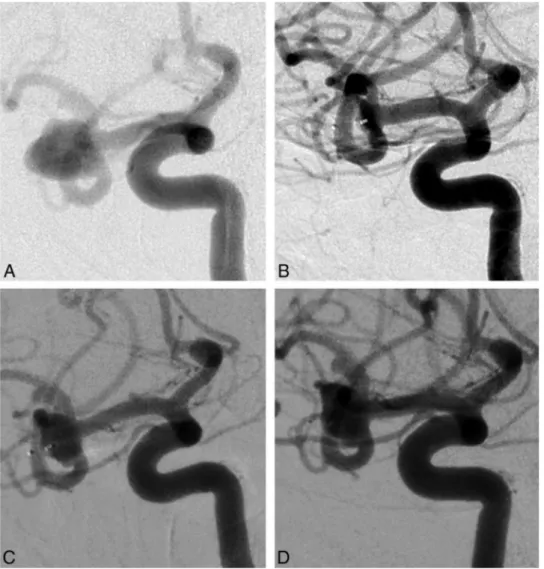 FIG 1. Case 1 (patient 5) involves a right unruptured MCA aneurysm in a 44-year-old woman