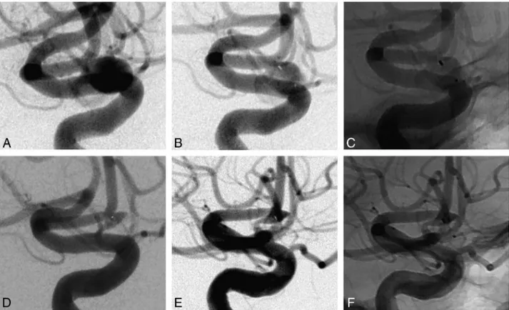 FIG 3. Case 3 (patient 1) involves an AcomA aneurysm in a 45-year-old man. A, Subtracted angiography of the internal carotid artery shows an AcomA aneurysm