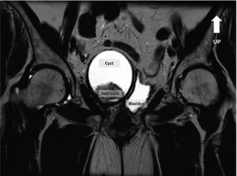 Figure 2. Magnetic resonance imaging confirmed the presence of a cystic  lesion with a thick solid inner area.