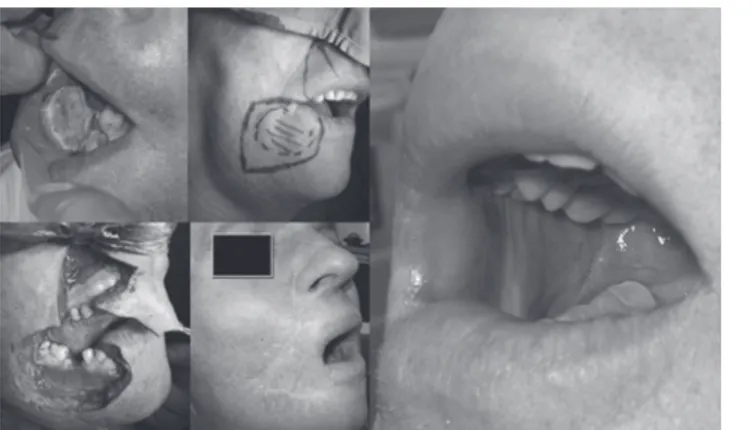 Fig. 1. Full thickness resection of the right cheek and labial  commissure, bilateral neck dissection and reconstruction with  abbé-estlander + FaMM flap.