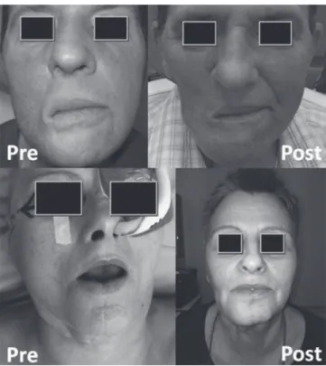 Fig. 4. Pre- and postoperative appearance of both patients; the  aesthetic deformity following a masseter flap reconstruction is  minimal.