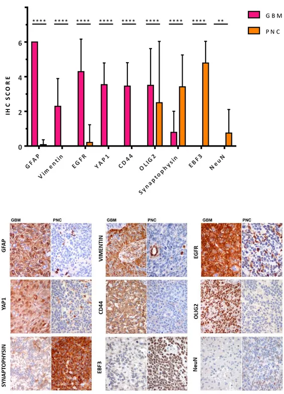 Figure 10. Analysis of glial and neuronal markers expression in GBM and PNC components 