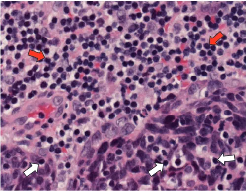 Fig. 2  Tumour infiltrating lymphocytes (white arrows) in HPV associated oropharyngeal carci- carci-noma
