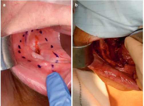 Fig. 1 (a, b) Peroral resection of a right-sided floor of mouth carcinoma