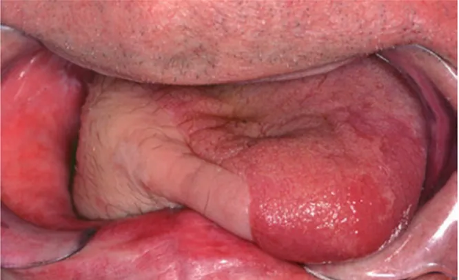 Fig. 4  End result after  removal of T3 right sided  oral tongue cancer that was  reconstructed by a free  radial forearm flap